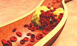Điều trị tăng cholesterol sau 7 năm vẫn nhồi máu cơ tim