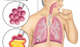 Nấm phổi do Aspergillus: Bệnh nguy hiểm nhưng &#237;t người biết