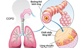 Ph&#242;ng ngừa bệnh phổi tắc nghẽn mạn t&#237;nh