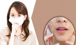 Xử lý trục trặc ở da do đeo khẩu trang kéo dài