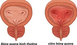 Vi&#234;m b&#224;ng quang t&#225;i ph&#225;t c&#243; nguy cơ g&#236;?