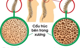 Cần sử dụng đúng thuốc trị loãng xương