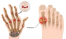 Gout căn bệnh của giới nhà giàu?