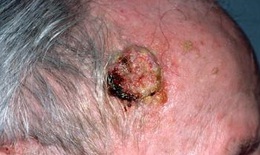 Thuốc lợi tiểu thiazide có thể làm tăng nguy cơ ung thư da