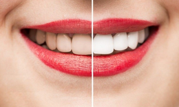 Tẩy trắng c&#243; l&#224;m ảnh hưởng men răng?