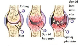 Bệnh thoái hóa khớp đang có xu hướng trẻ hóa