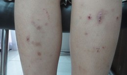 Làm sao biết bị nhiễm giun từ chó mèo?