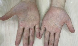 Người lớn chăm sóc trẻ mắc bệnh tay - chân - miệng: Không nên chủ quan