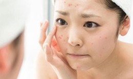 Khắc phục phản ứng do da nhạy cảm