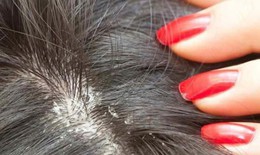 Nấm da đầu, điều trị sao cho hiệu quả?