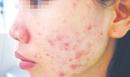 Xử trí dị ứng mỹ phẩm