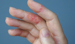 Nhiều bệnh về da dễ bùng phát trong mùa lạnh