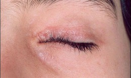 Bệnh vảy nến vùng mắt - Cẩn thận biến chứng