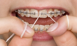 Sau niềng răng phải biết giữ g&#236;n v&#224; vệ sinh răng miệng
