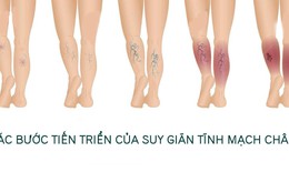 Bài tập cho người suy giãn tĩnh mạch chân
