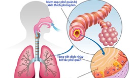 C&#244;ng ph&#225;p trị liệu vi&#234;m phế quản mạn t&#237;nh &#160;