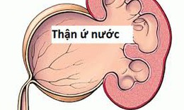 Thận ứ nước kéo dài dễ tổn thương vĩnh viễn