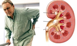 Tự ý dùng thuốc nam chữa sỏi thận: Coi chừng tử vong
