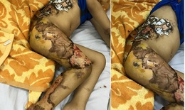 Hà Nội: Bé trai 4 tuổi hoại tử da vì đắp lá chữa bỏng
