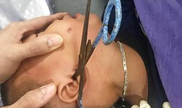 Cha mẹ lơ là, bé trai 2 tuổi bị kéo cắm ngập vào tai