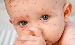 Báo động: Dịch sởi bùng phát tại nhiều nơi có tỷ lệ tiêm phòng sởi thấp