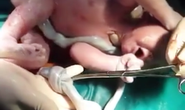Video cận cảnh em bé bị dây rau thắt nút chào đời khỏe mạnh