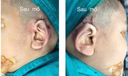 Lần đầu tiên sửa chữa dị tật “hai tai bỏ túi” bằng kỹ thuật mới