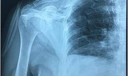 Bệnh nhân bị đâm thấu ngực, có nhóm máu hiếm thoát chết hi hữu