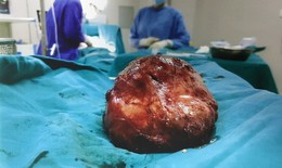 Giải thoát cho bệnh nhân 30 năm "đeo" khối bướu giáp khổng lồ
