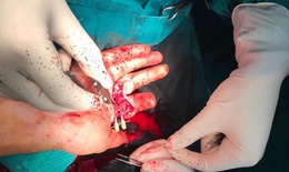 Vi phẫu nối 2 ngón tay đứt rời cho nam thanh niên bị tai nạn
