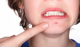 6 c&#225;ch để mụn trứng c&#225; kh&#244;ng “nở rộ” tr&#234;n khu&#244;n mặt
