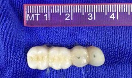 Hi hữu 4 chiếc răng sứ "chui" vào phế quản cụ ông 90 tuổi khi đang lắp răng