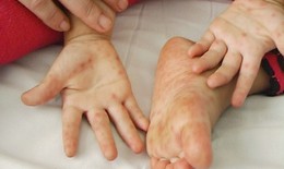 Làm sao để phát hiện bệnh tay chân miệng ở trẻ mầm non?