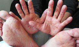 Chuyên gia dịch tễ: Đa số trẻ tử vong vì tay chân miệng do tự điều trị tại nhà