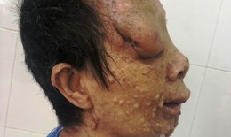 Người phụ nữ mọc u chi chít khắp người, hơn 10 năm không dám ra khỏi nhà