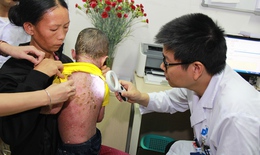 B&#233; trai bong tr&#243;c da to&#224;n th&#226;n &quot;thay da đổi thịt&quot; kh&#244;ng ngờ sau 10 ng&#224;y điều trị