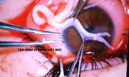 Kỹ thuật mới 'giải thoát' mù loà cho bệnh nhân loét giác mạc do mất cảm giác