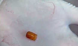 Gắp dị vật cho bé trai gây xẹp toàn bộ nửa phổi phải