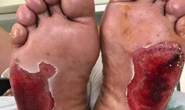 Thủng toác bàn chân vì chữa đái tháo đường bằng “Cặp đá kỳ diệu”