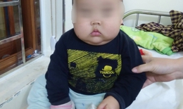 Bé trai suy thượng thận, mặt phù to như quả bí đỏ vì uống thuốc chứa corticoid
