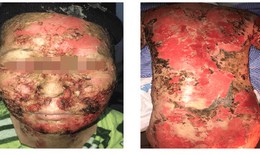 Tự tắm lá, cúng bái chữa bệnh, một phụ nữ bị "lột da", bốc mùi hôi thối