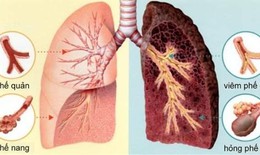 90% ung thư phổi c&#243; nguy&#234;n nh&#226;n từ việc h&#250;t thuốc l&#225;, h&#227;y tr&#225;nh xa kh&#243;i thuốc