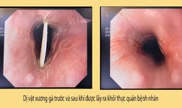 Xương gà cắm sâu trong thực quản cụ già sau khi ăn cỗ
