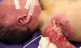 Ghép da cứu bé trai 2 tuổi bị bỏng nước sôi toàn thân thương tâm
