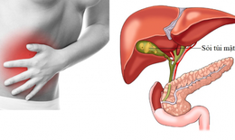Biến chứng khó lường nếu không chữa sỏi mật, người dân nên khám sức khỏe thường xuyên