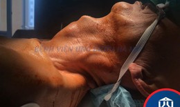 Mở khí quản tư thế nằm nghiêng cứu cụ ông mắc u khí quản hiếm gặp