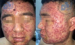 Mua thuốc trị mụn trên facebook, không ngờ trứng cá nở rộ khắp mặt phải "cầu cứu" bác sĩ