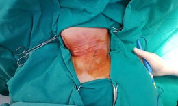 Cụ bà hóc xương cá thủng thực quản, gây mủ trắng hôi thối ở cổ