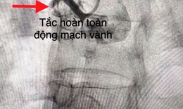 Cảnh báo cơn đau ngực dữ dội có thể gây tử vong nhanh chóng