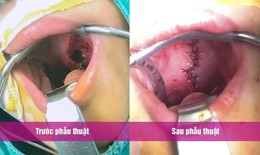 Bé trai 2 tuổi bị đũa chọc rách vòm miệng